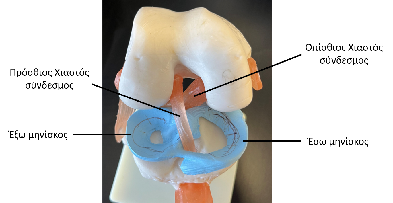 Anterior Cruciate Ligament Rupture
