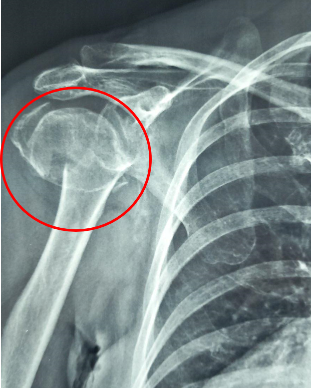 ΚΑΤΑΓΜΑ ΒΡΑΧΙΟΝΙΟΥ