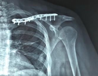 ΚΑΤΑΓΜΑ ΚΛΕΙΔΑΣ