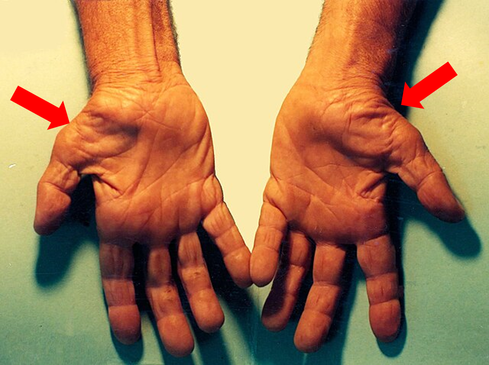 ΣΥΝΔΡΟΜΟ ΚΑΡΠΙΑΙΟΥ ΣΩΛΗΝΑ