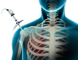 Shoulder Arthroscopy Operations